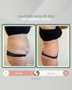 beautysculpt antes e depois 2