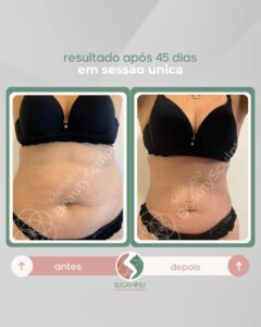 beautysculpt antes e depois