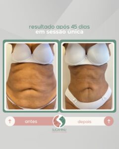 beautysculpt antes e depois 3